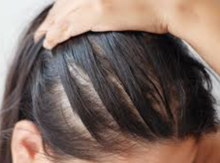 Thinning, sparse, lackluster hair